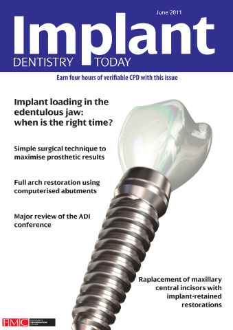 IDT – Implant Dentistry Today issue June 2011 Vol 5 Issue 2