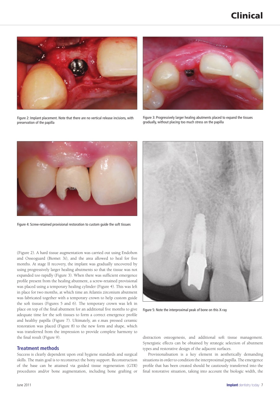 IDT – Implant Dentistry Today Preview Pages