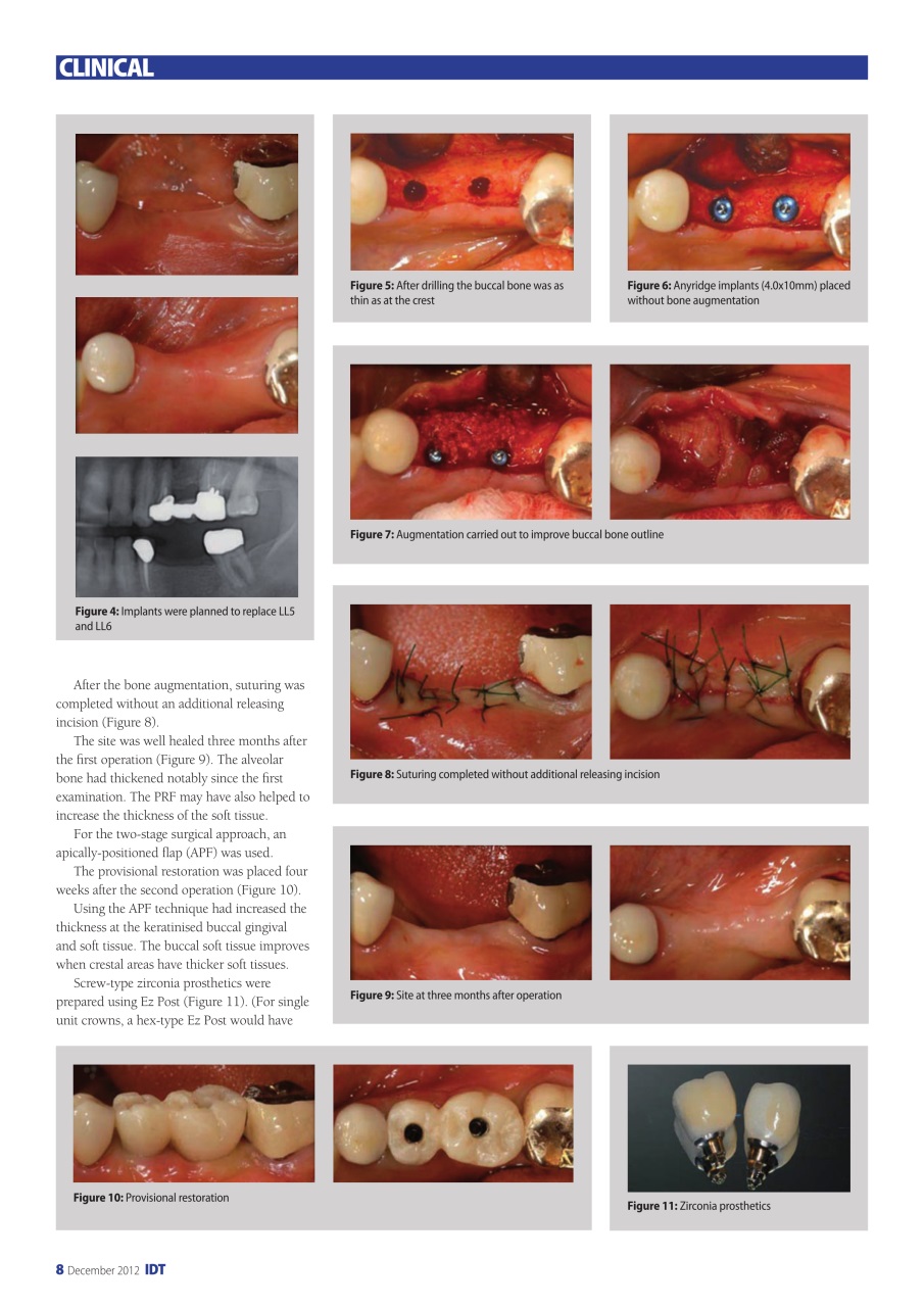 IDT – Implant Dentistry Today Preview Pages